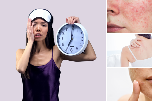 7 Tips Pola Hidup Sehat untuk Kulit Bebas Jerawat 7 Tips Pola Hidup Sehat untuk Kulit Bebas Jerawat