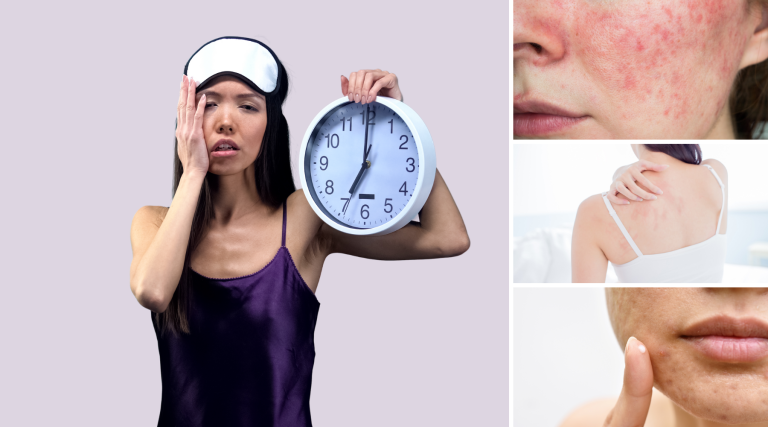 7 Tips Pola Hidup Sehat untuk Kulit Bebas Jerawat