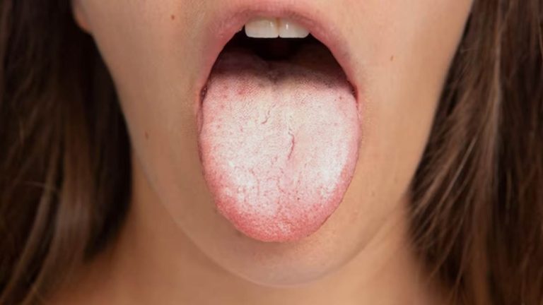 7 Cara Atasi Lidah Terasa Asam atau Aneh