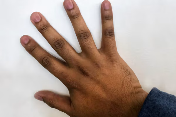7 Cara Mengembalikan Warna Kulit Tangan yang Gelap karena Matahari