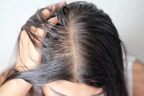 7 Cara Mengurangi Rambut Berminyak Secara Alami