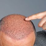 10 Tips Merawat Rambut Setelah Transplantasi