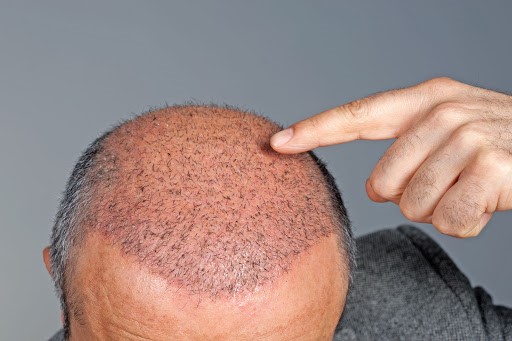 10 Tips Merawat Rambut Setelah Transplantasi